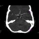 A tiny intracranial aneurysm on the branching ICA: CT - Computed tomography